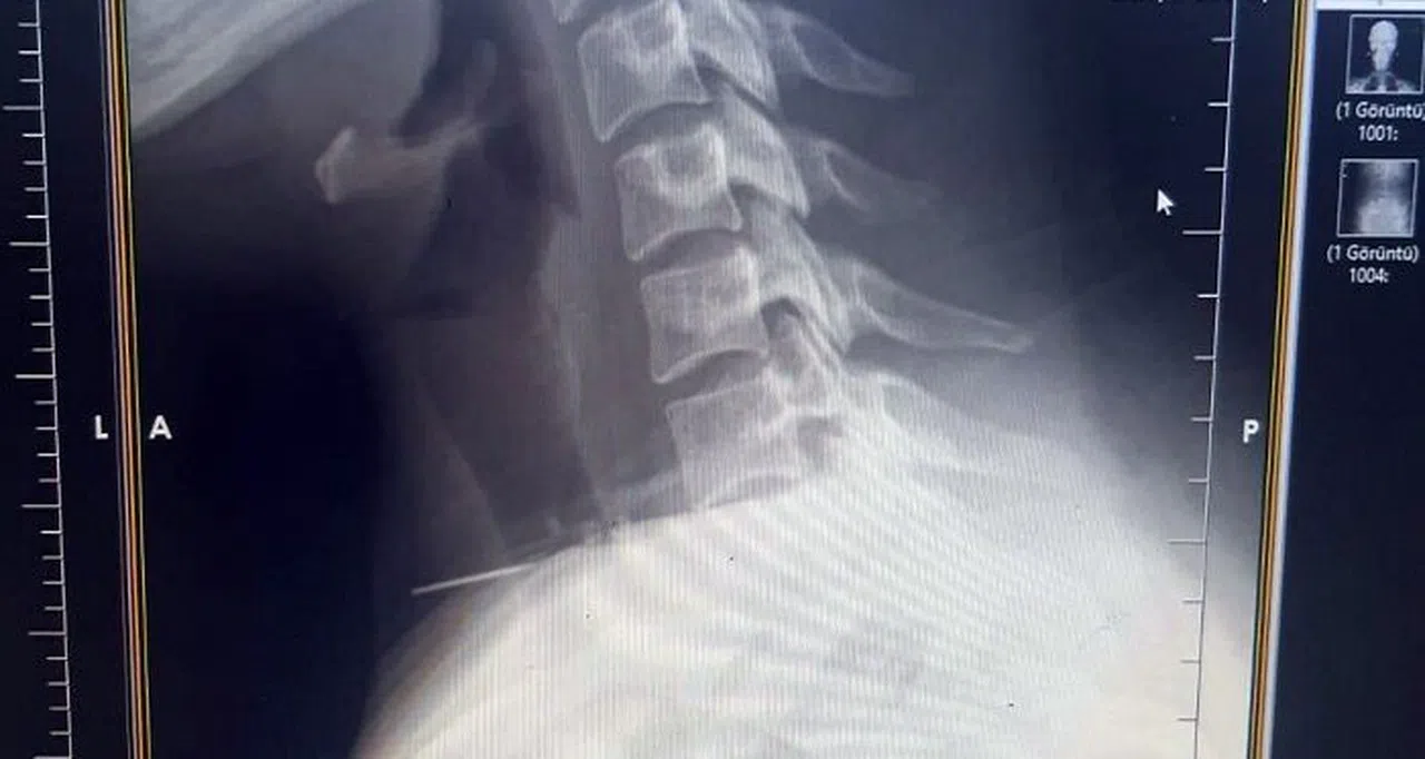 Kadının Boğazına Saplanan İğne Ameliyatla Çıkarıldı