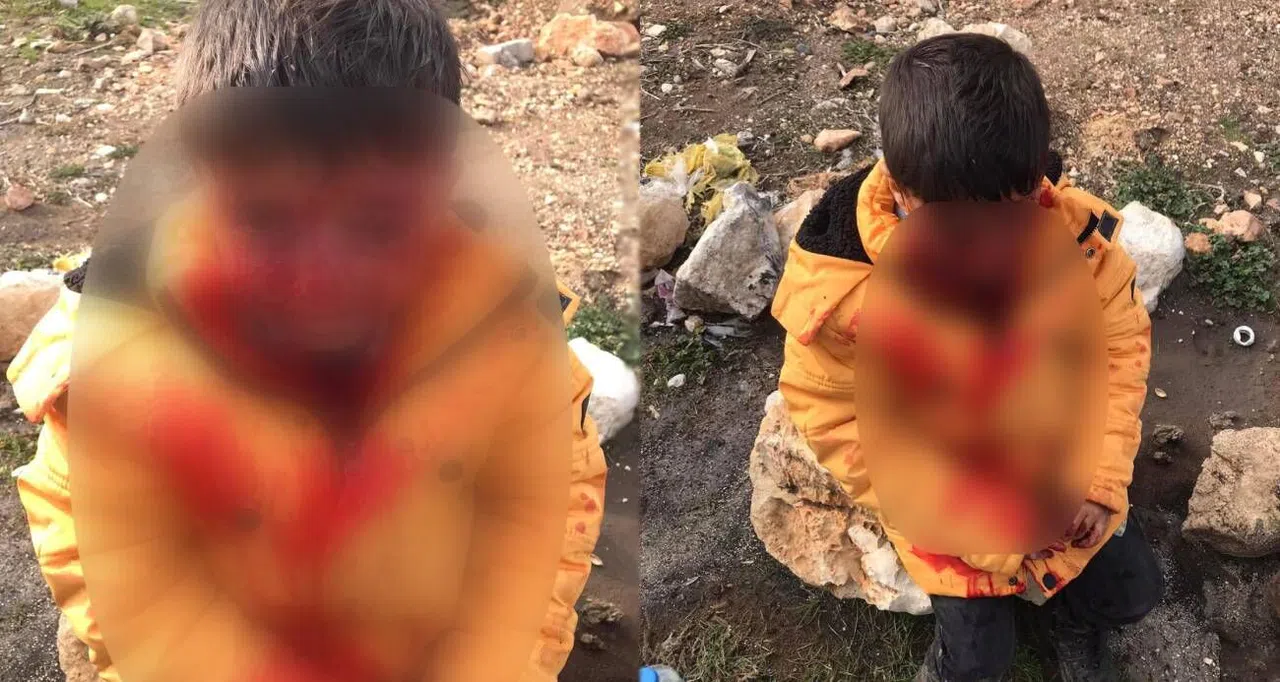 Başıboş Köpeklerin Saldırdığı Çocuk Ağır Yaralandı