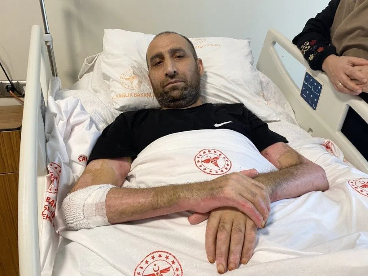 Mangal Yapmak İsterken ’Tiner Faciası’: Vücudunun Yüzde 80’i Yandı