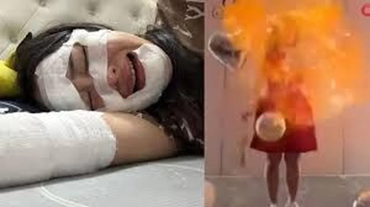 Doğum gününde elinde patlayan balon kadının yüzünü yaktı