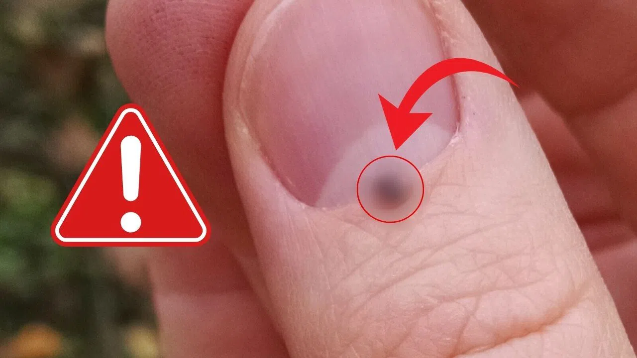 Kahramanmaraş’ta Sessiz Tehlike: Kene Isırığına Dikkat!