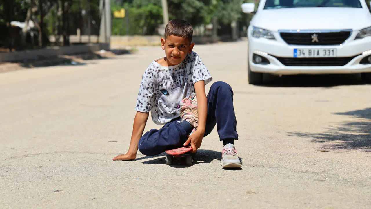 Kaza Sonrası Ayağı Yanlış Kaynadı, Hayatı Kaykay Üzerinde Geçiyor