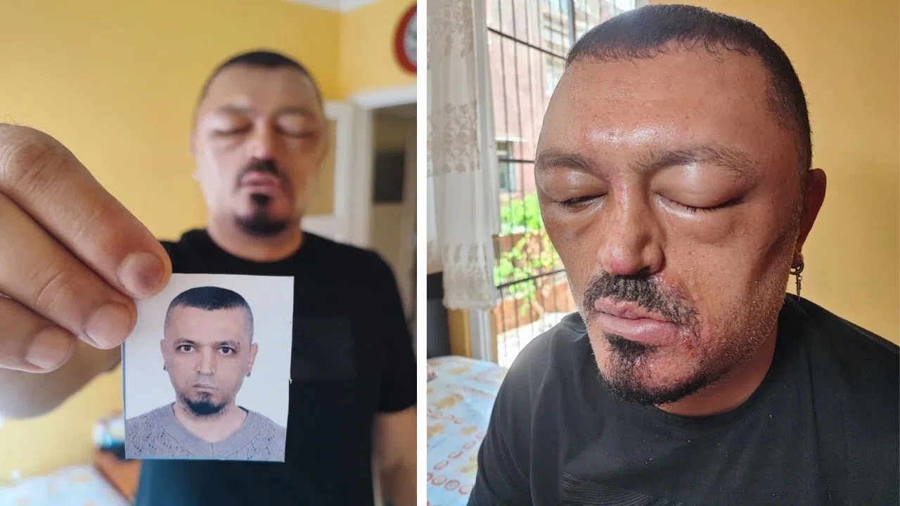 Saç Şampuanı Alerjiye Yol Açtı: Yüzü ve Gözleri Şişti