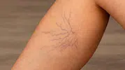 Yazın belirginleşen bacak damarlarına dikkat! Uzmanlardan toplardamar yetmezliği uyarısı