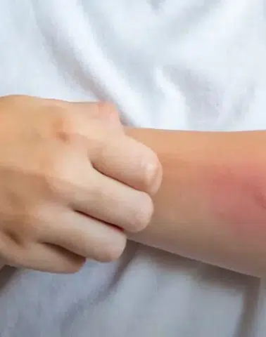 Egzama yalnızca cildi değil, sosyal yaşamı da etkileyebiliyor