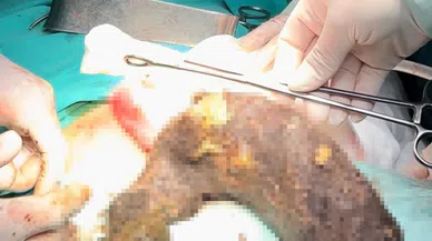 15 yıldır saç yeme alışkanlığı olan genç kızın karnından 2 kilogram kıl yumağı çıktı