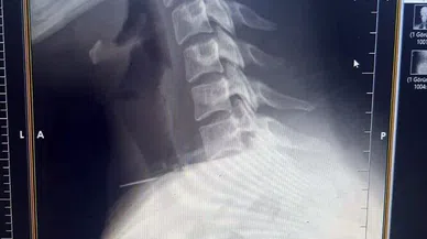 Kadının Boğazına Saplanan İğne Ameliyatla Çıkarıldı