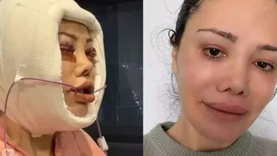 Yüz nakli olan ünlü isimden acı haber geldi!