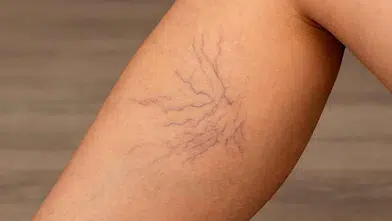 Yazın belirginleşen bacak damarlarına dikkat! Uzmanlardan toplardamar yetmezliği uyarısı