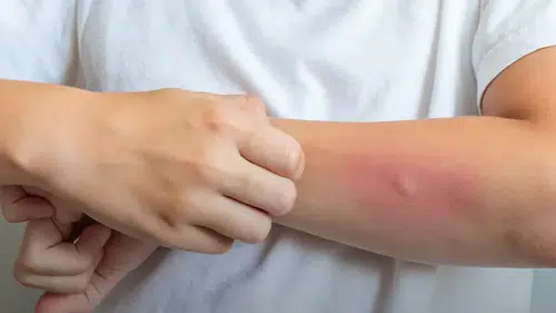 Egzama yalnızca cildi değil, sosyal yaşamı da etkileyebiliyor