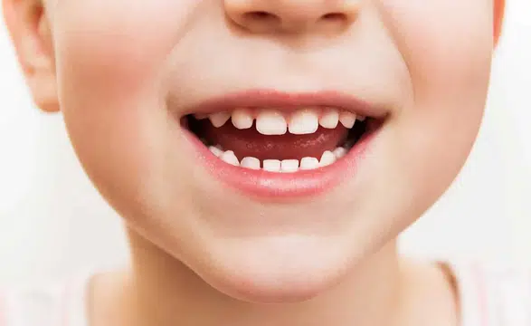 Uzmanlar Uyardı Çocuklarınızın Diş Sağlığı İçin Bunlar Şart!