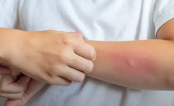 Egzama yalnızca cildi değil, sosyal yaşamı da etkileyebiliyor