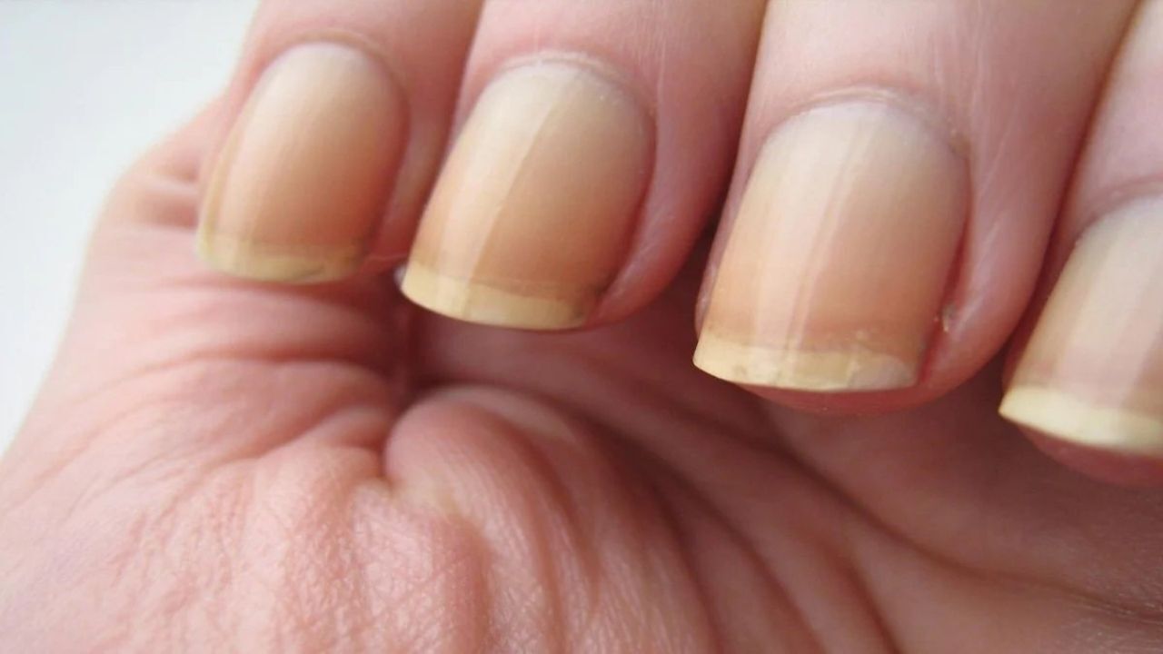 Sadece 1 damlası yetiyor! Tırnaklardaki sararmayı anında yok ediyor 1