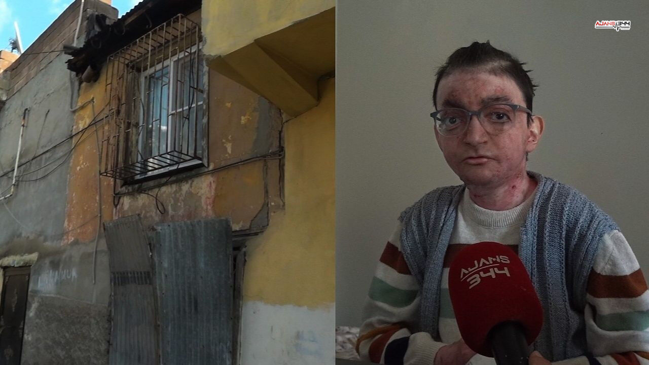 Kelebek Hastası Genç Ajans344 (2)