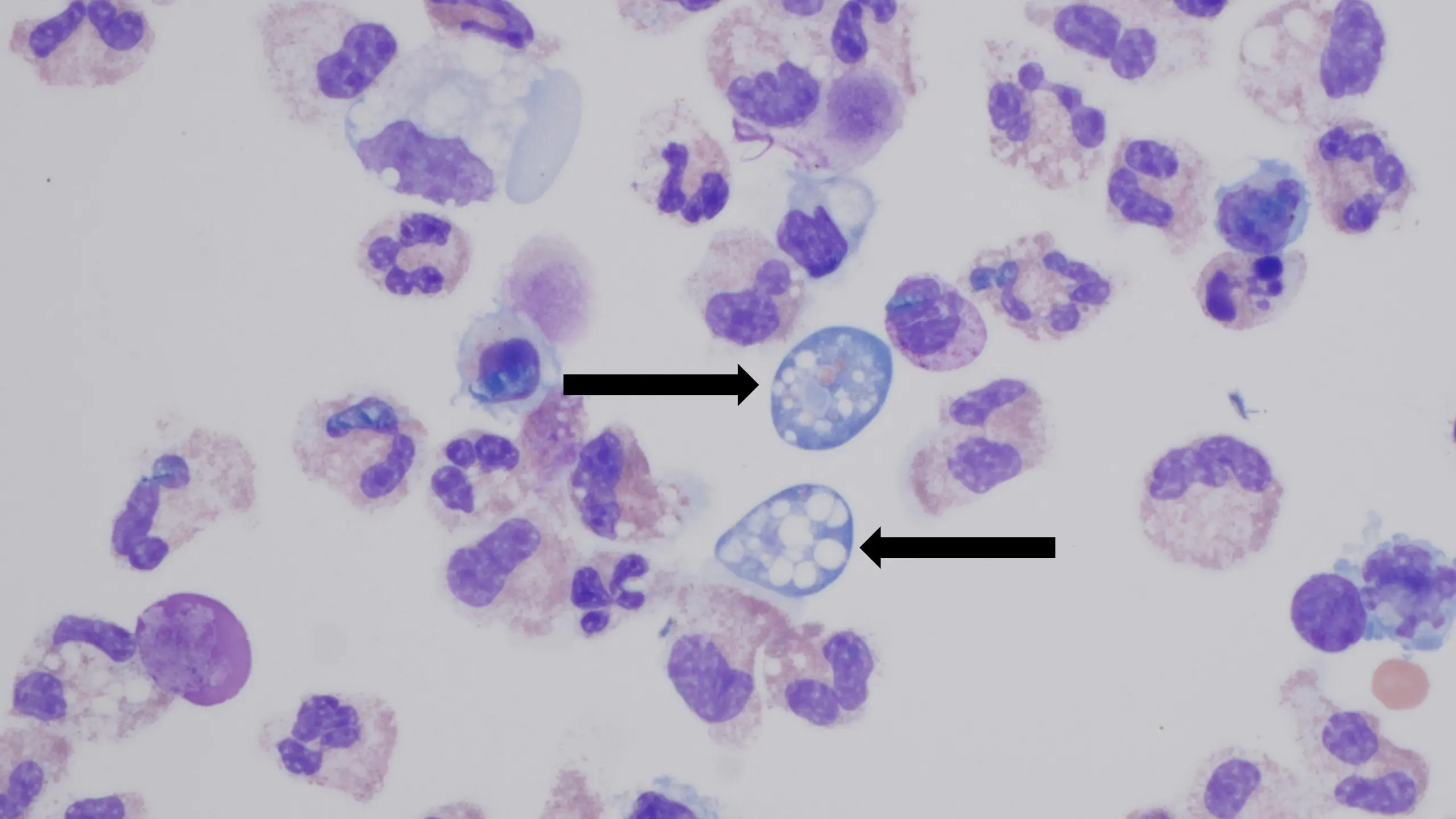 Naegleria fowleri Infections | Naegleria fowleri Infection | CDC